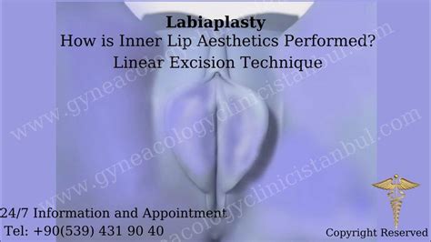 what is labiaplasty how is labiaplasty performed type 1 linear labiaplasty barbie vagina youtube