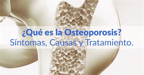 ¿qué Es La Osteoporosis Conóce Los Síntomas Y El Tratamiento