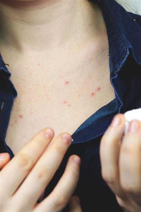 The Dermatologist Approved Way To Treat Chest Acne Once And For All