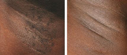 Few contradictions include darker and tanned skin. Laser Hair Removal Armpit / Underarm « DERMAWORLD SKIN CLINIC