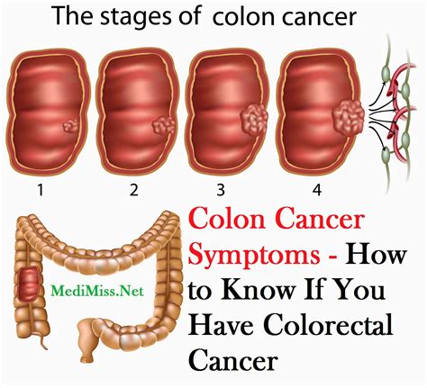 If you are due for colorectal cancer screening, do not wait. What Are The Symptoms Colon Cancer | MedicineBTG.com