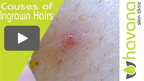 Ingrown Hair Removal Close Up 3 Main Causes Of Ingrown Hairs Youtube