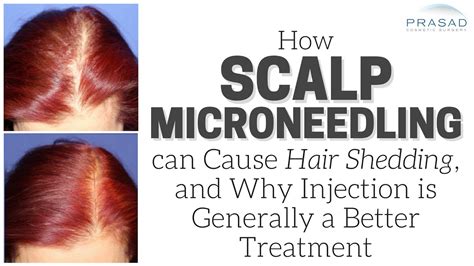Microneedling is a minimally invasive cosmetic treatment that involves puncturing the skin using fine needles or dermaroller to boost your skin's collagen production. How Scalp Microneedling can Cause Temporary Hair Shedding ...