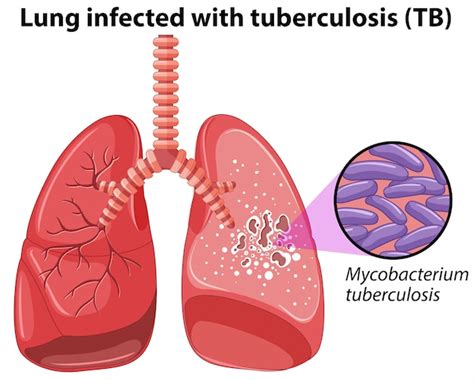 Infografía De Tuberculosis Ilustración Vectorial Vector Premium