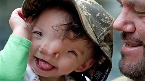 3d Printing Helps Give Girl A New Face Cbc News