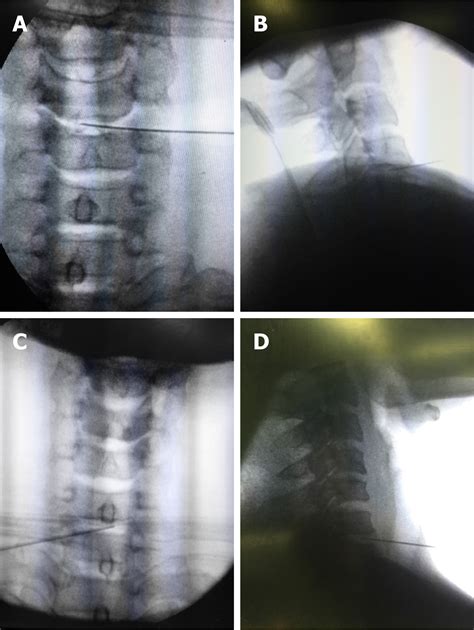 Pyogenic Discitis With An Epidural Abscess After Cervical Analgesic
