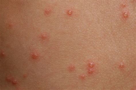 Chickenpox Symptoms Nhsuk