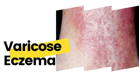 Natural Treatments For Varicose Eczema Vein Solutions