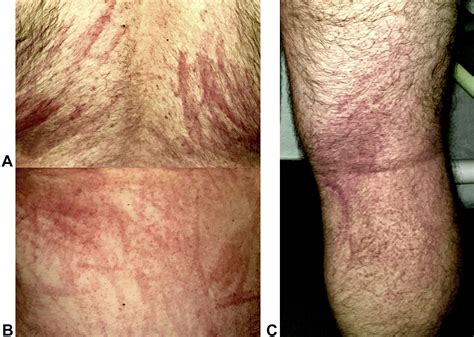 A Case Of Flagellate Dermatitis After Ingestion Of Shiitake Mushrooms
