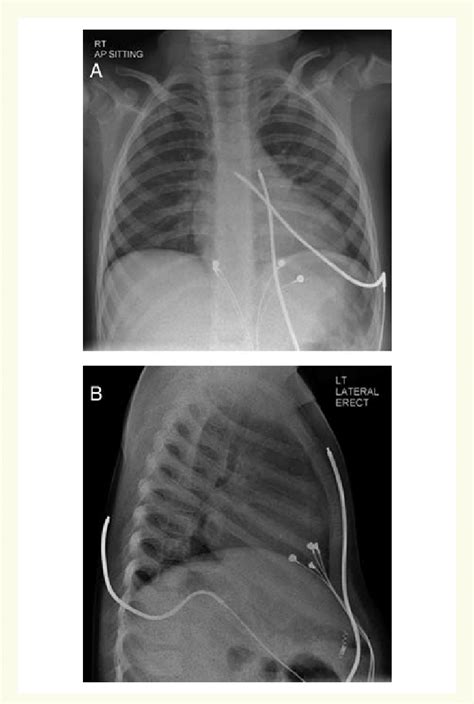 A And B Chest Radiographs Ap And Lateral Demonstrating The Hybrid