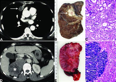 Ct Scans Macroscopic And Histological Appearances Of Pulmonary
