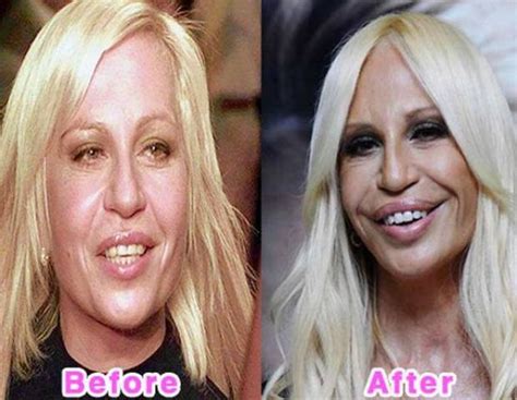 Donatella Versace Bad Celebrity Plastic Surgery Celebrity Plastic Surgery Plastic Surgery
