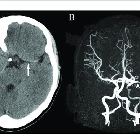 Head Ct Showing A Hyperdense Mca Sign Involving The M1 Segment And