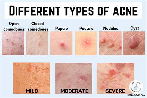 Different Types Of Acne With Pictures Their Treatment