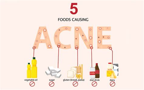 What Foods To Avoid For Acne