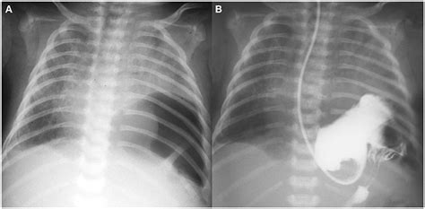 Frontiers Rare Course Of Bilateral Congenital Diaphragmatic Hernia