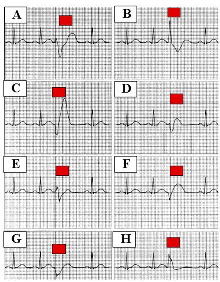 Types Of Pvcs