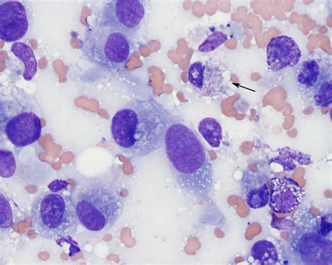 Sarcoma | eClinpath