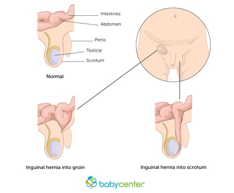 A hernia occurs when tissue bulges out through an opening in the muscles. Hernias | BabyCenter
