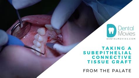 Taking A Subepithelial Connective Tissue Graft From The Palate 🦷 Youtube