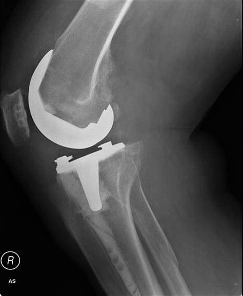 Partial Knee Replacement As Effective As Tkr Also Cost Effectivestudy