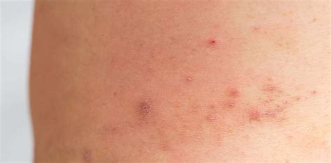 Ichthyosis Vulgaris Causes Clear Skin Clinic