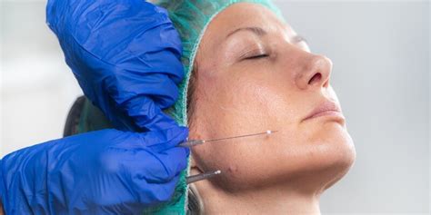 Is The Thread Lift Procedure The New Face Lift