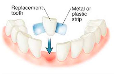 Dental Bridge Procedure Dental Bridge Vs Dental Implant