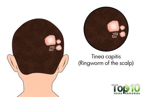 Home Remedies For Ringworm Of The Scalp Top 10 Home Remedies
