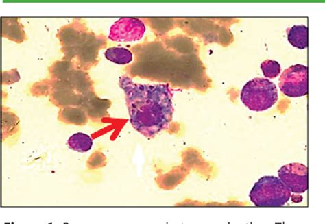 Figure 1 From Pancytopenia And Progressive Splenomegaly In Patient With