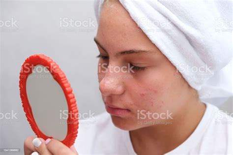 Sad Teenage Girl Problematic Skin In Adolescents Stock Photo Download