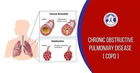 An Information Guide To ‘chronic Obstructive Pulmonary Disease