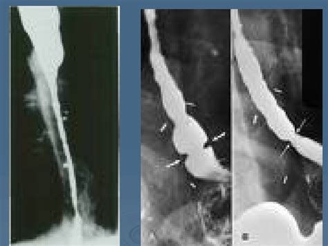 Sophageal Disease Stricture Diverticula