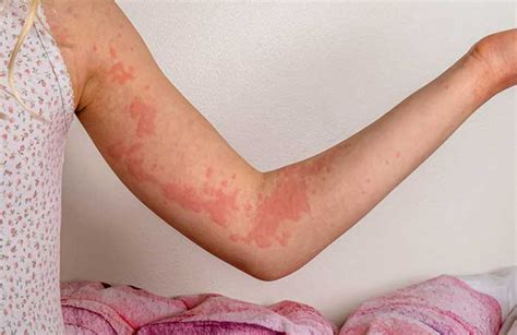 Hives And Swelling Aka Urticaria And Angioedema