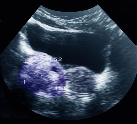 Dermoid Ovarian Cyst Photograph By Zephyrscience Photo Library