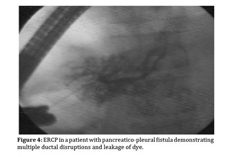 Pancreatico Pleural And Bronchial Fistulae And Associated Pseudoc
