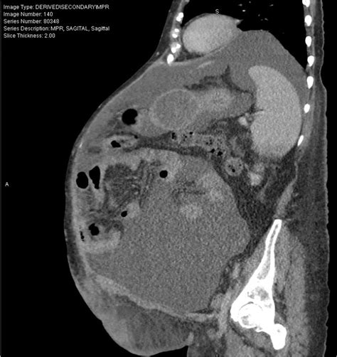 Figure 5 Ct Scan Showing Tense Ascites Bulging Into The Thoracic