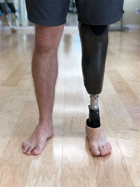 Prosthetic Silicone Skins For Amputees Prosthetic Leg Prosthetics