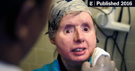 Chimpanzee Attack Victim Who Got Face Transplant Is Hospitalized The