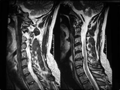 Spine surgery should always be taken seriously. Herniated Disc Causes Neck Pain