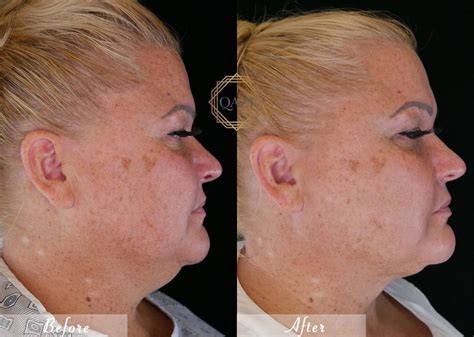 Non Surgical Neck Lift Top 5 Ways To Revitalize Your Neck