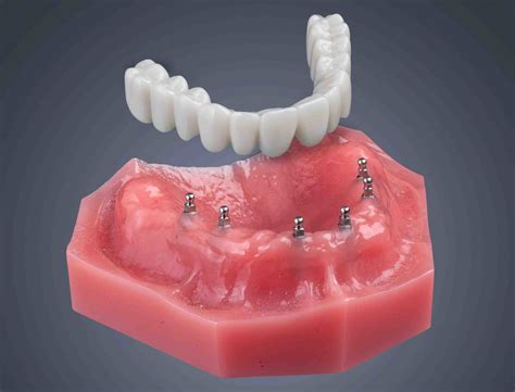 How Long Do Mini Dental Implants Last Dental News Network