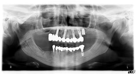Implantologia A Carico Immediato Studio Dentistico Dv Dent