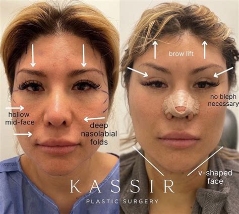 Cat Eye Facelift And Midface Lift In New York — Kassir Plastic Surgery