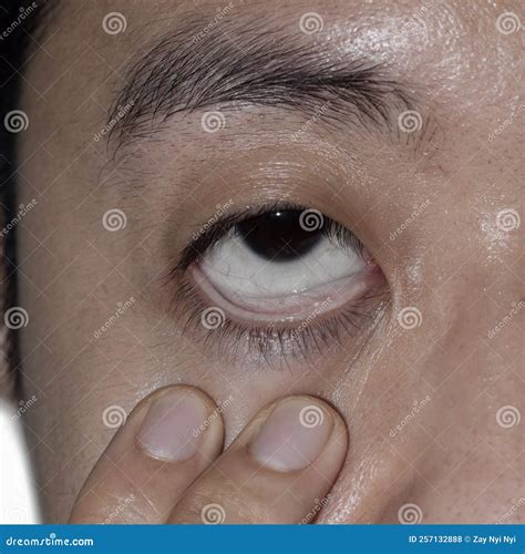 Sign Of Anemia Pallor At Eyelid Stock Photo Image Of Burmese