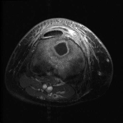 Osteomyelitis Proximal Tibia Image