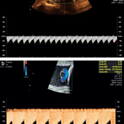 Middle Cerebral Artery Mca Doppler Waveforms Obtained From The