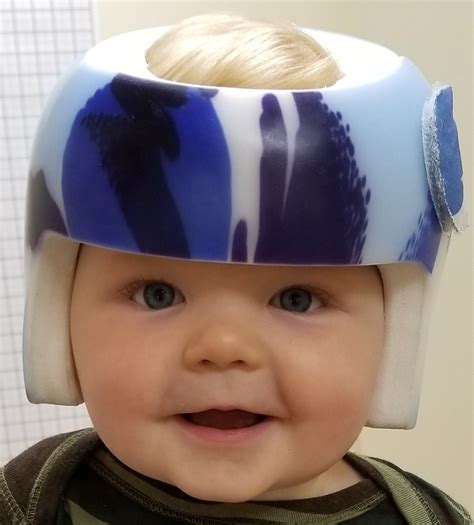 Shaping Helmets For Babies