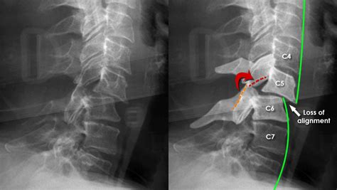 Dislocated Neck X Ray