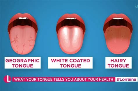 what your tongue can tell you about your health liverpool echo